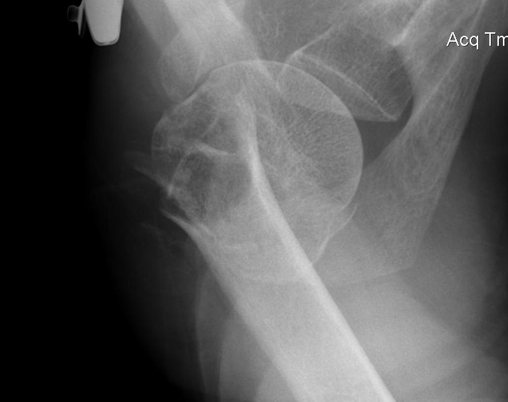 SNOH Displaced 2 Part Fracture Axillary Lateral
